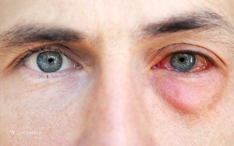 درمان آلرژی چشمی چیست؟