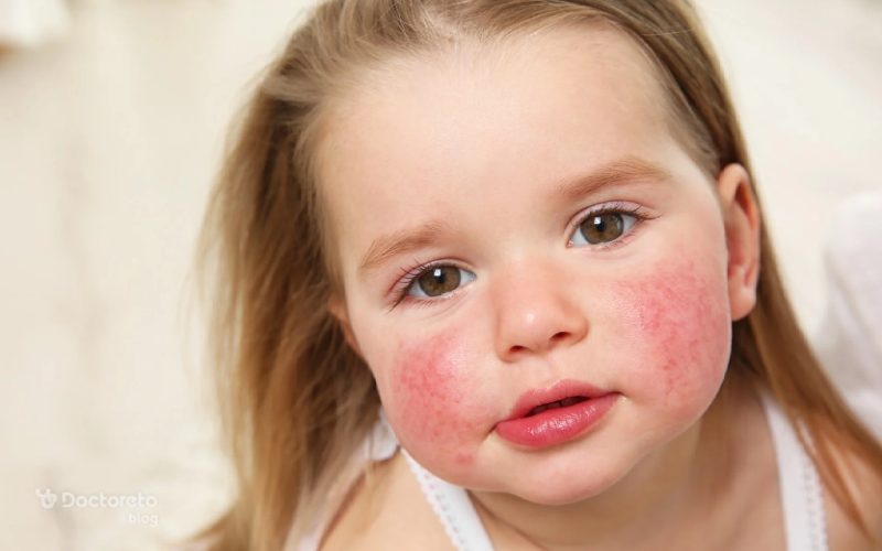 جلوگیری از آلرژی ممکن است؟