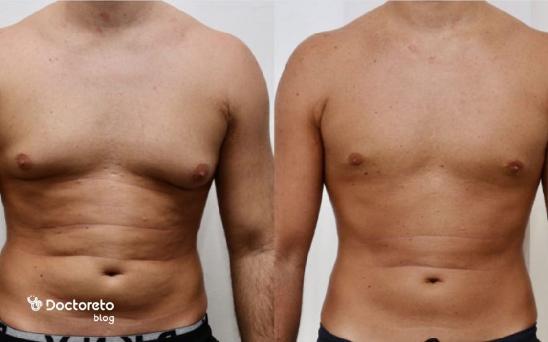دوره نقاهت عمل ژنیکوماستی
