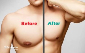 عمل ژنیکوماستی با لیزر چیست؟ | مزایا و عوارض لیزر ژنیکوماستی