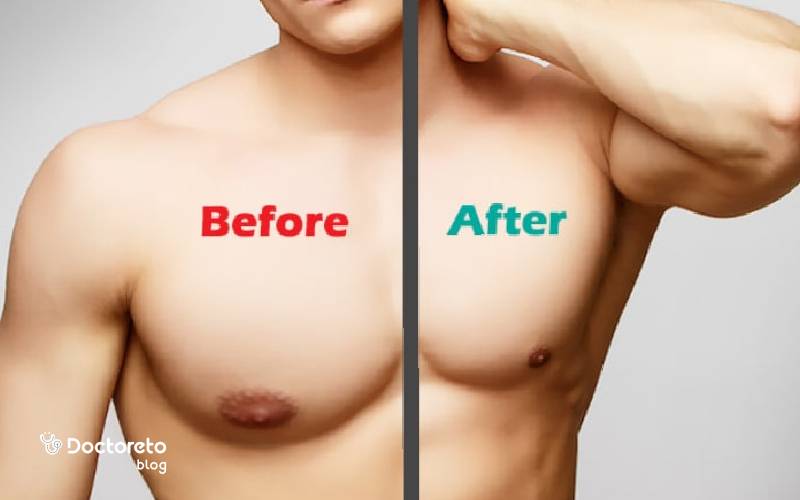 عمل ژنیکوماستی با لیزر چیست؟ | مزایا و عوارض لیزر ژنیکوماستی