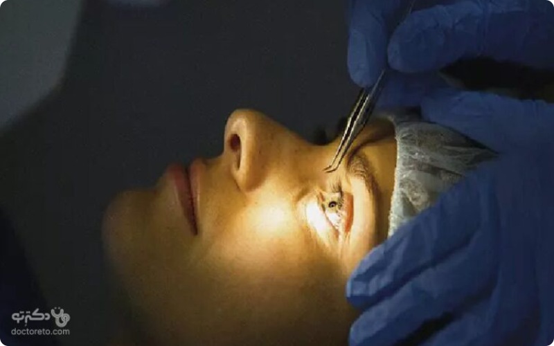 سن مناسب برای عمل لیزیک چشم چقدر است؟