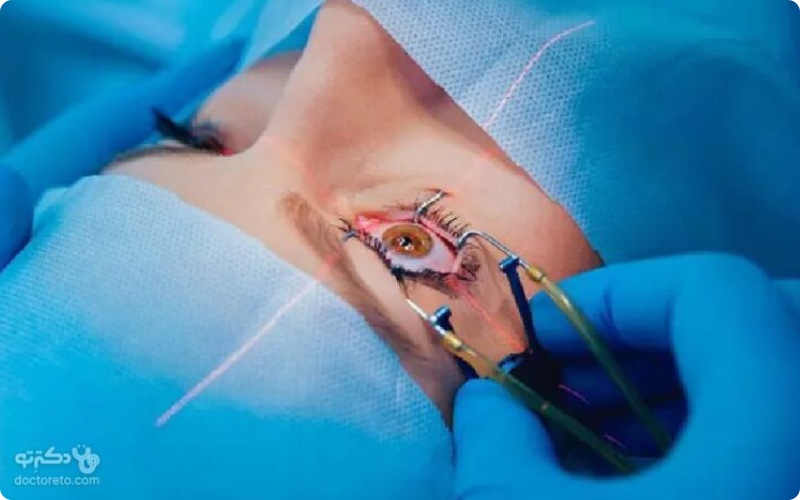 مراحل انجام عمل جراحی لیزیک چشم چه هستند؟