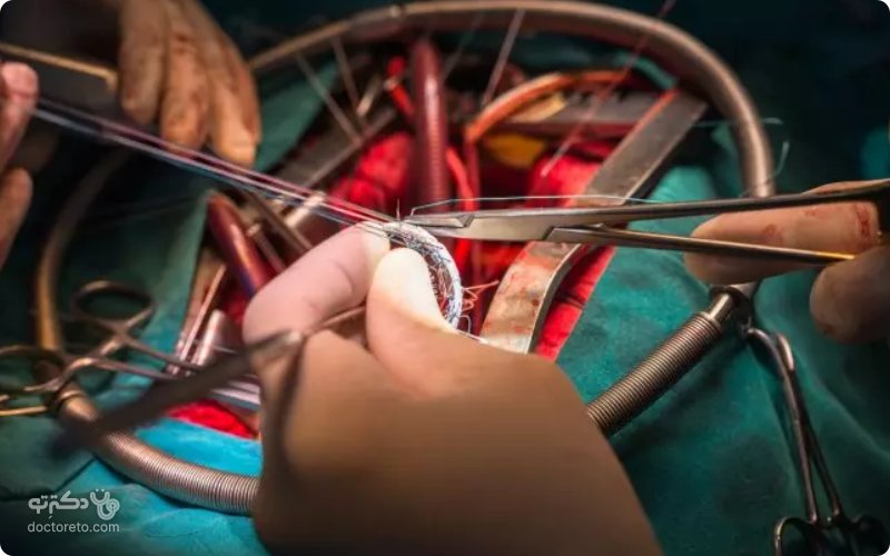 آیا جایگزینی برای جراحی قلب باز استاندارد وجود دارد؟