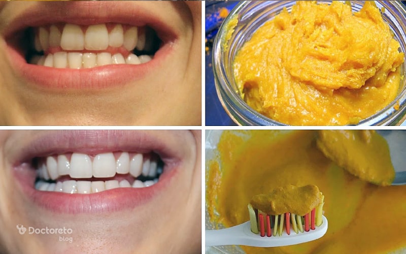 مزاج صفراوی باعث زردی دندان می‌شود.
