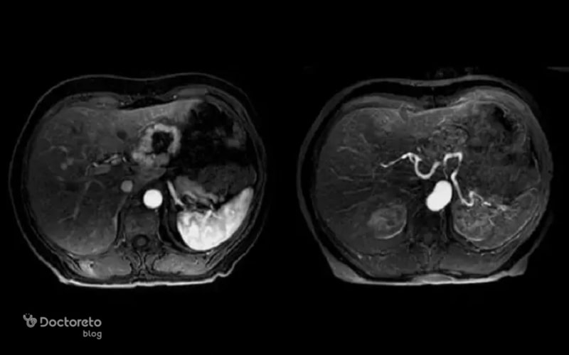 MRI شکمی تصویر دقیقی از بافت‌ها و اندام‌های درون شکم ارائه می‌دهد.