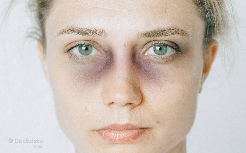 علت کبودی زیر چشم در مردان و زنان چیست؟