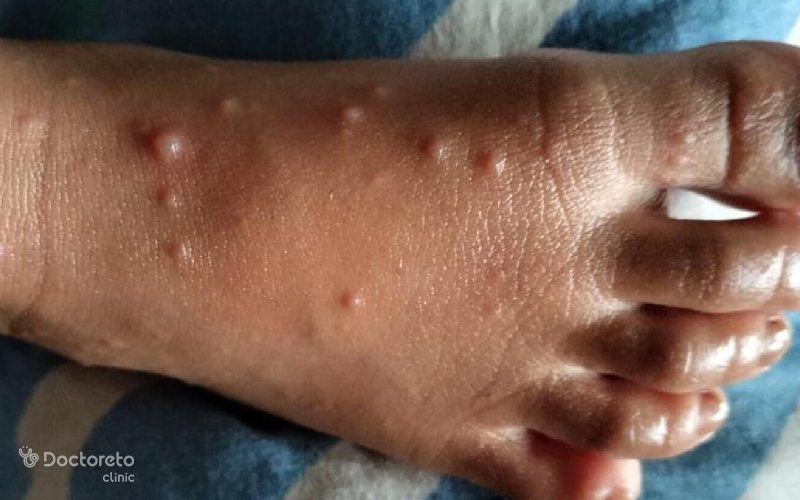 درمان خانگی خارش ویروس دست و پا چیست؟