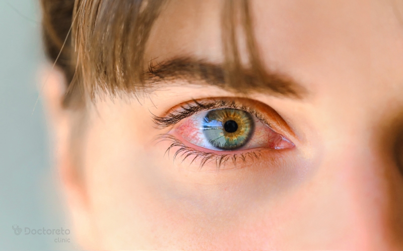 عفونت چشم یکی از انواع عفونت است