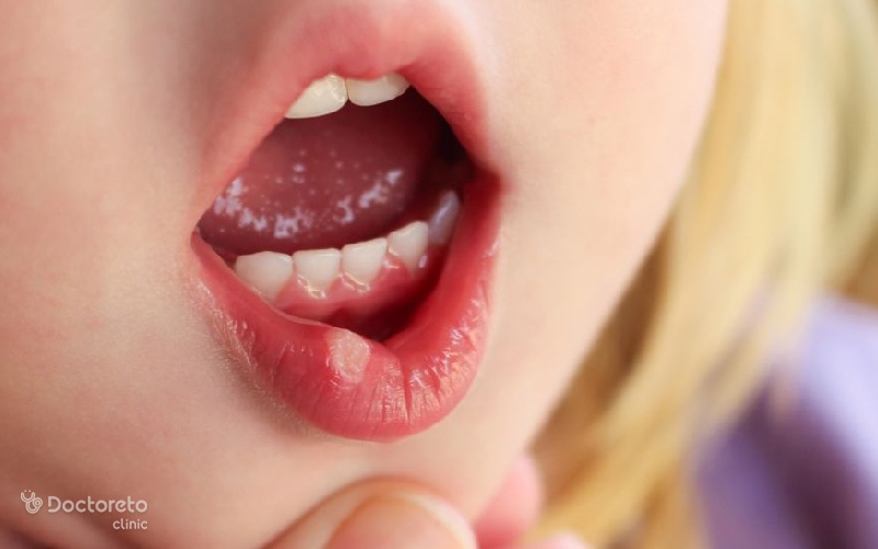 پودر و قرص نیستاتین برای آفت دهان مناسب است؟