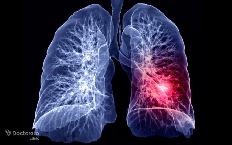 آمبولی ریه بعد از زایمان طبیعی و سزارین خطرناک است؟