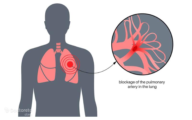 علائم آمبولی ریه چیست؟
