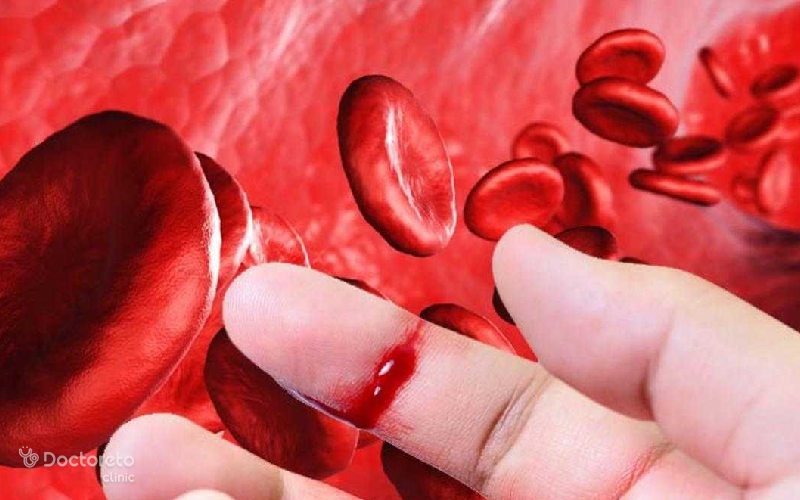 شایع ترین نوع کم خونی هموفیلی چیست؟
