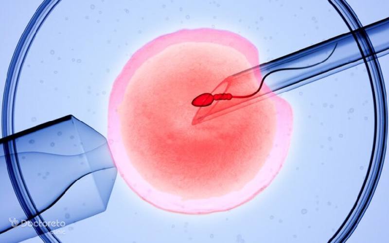 تزریق اسپرم داخل سیتوپلاسمی یا میکرو اینجکشن چه زمانی انجام می شود؟