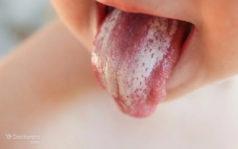 علت برفک دهان کودکان چیست؟