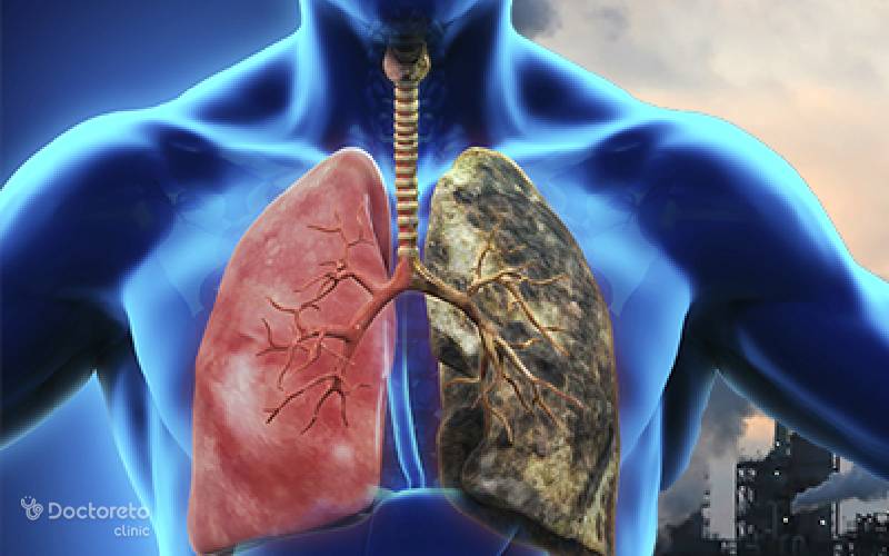 عفونت دستگاه تنفسی تحتانی چیست؟