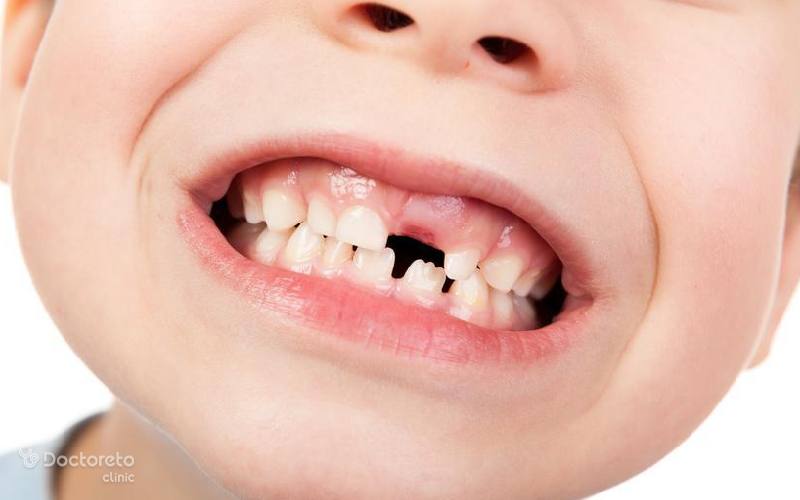 عوامل خطر دندان قروچه چیست؟