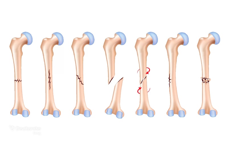 انواع شکستگی استخوان به دلیل ایجاد نیروی شدید ایجاد می شوند.