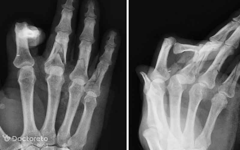 تصویر اشعه ایکس شکستگی انگشت دست را مشاهده می‌کنید.