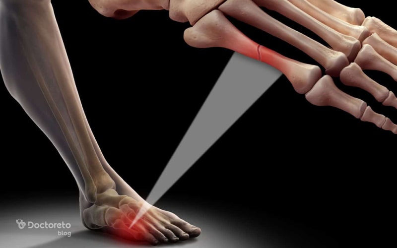 عوامل خطر شکستگی کف پا ضربه و پریدن است.