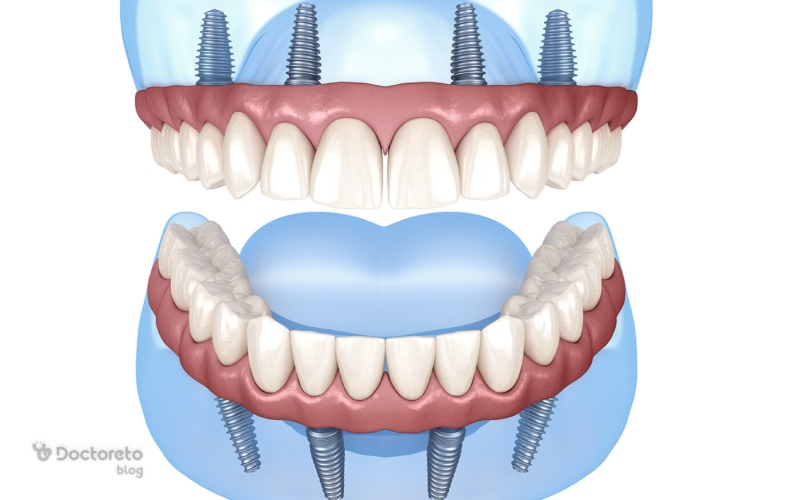 آیا کاشت دندان به روش all-on-4 روش جدید کاشت دندان بدون ایمپلنت است؟