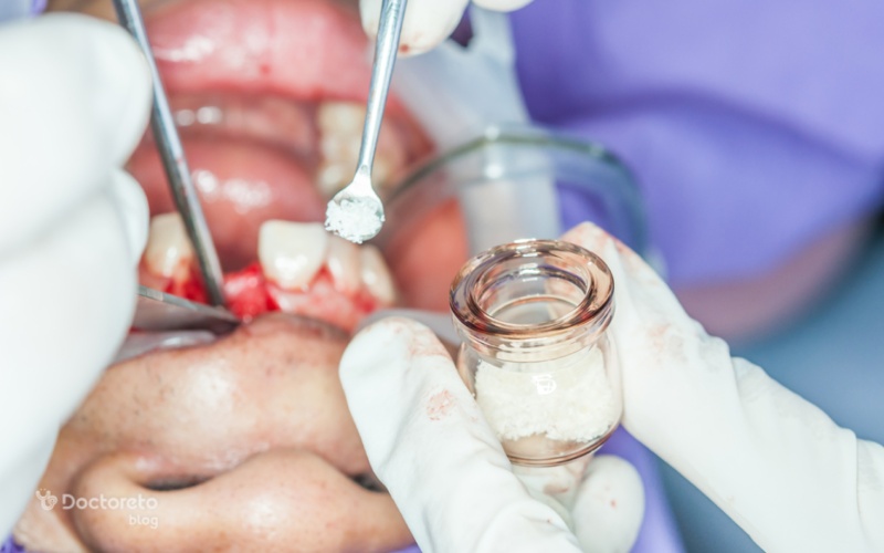 معایب و عوارض پیوند استخوان در ایمپلنت دندان چیست؟