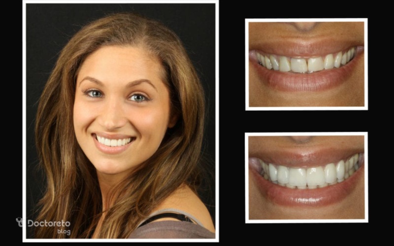 عدم آماده سازی کامل دندان ها قبل از لمینت چه عوارضی دارد؟