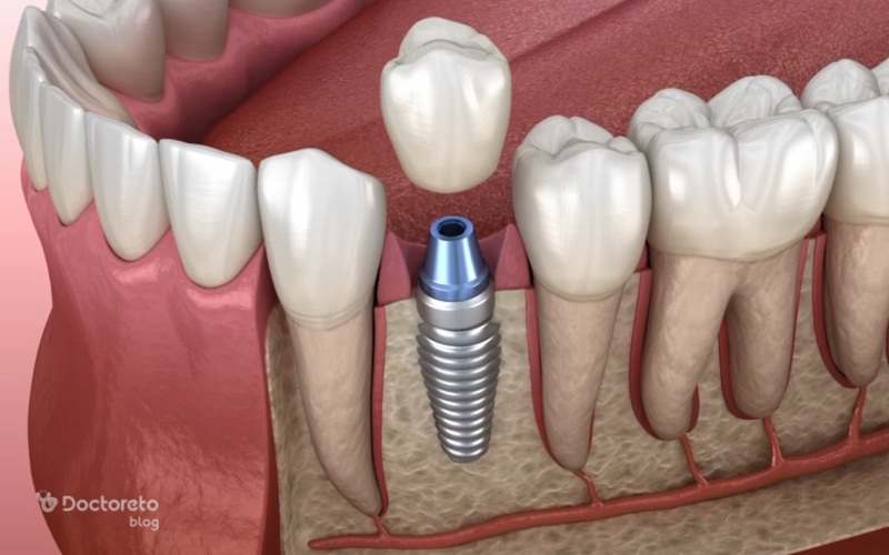 سوراخ شدن بافت اطراف ایمپلنت دندان چه علتی دارد؟