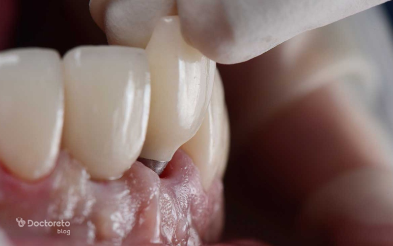 شل شدن ایمپلنت دندان چه دلیلی دارد؟