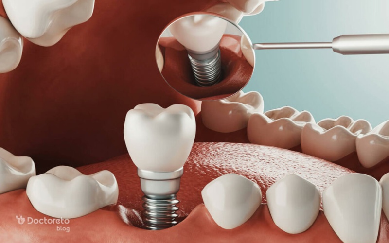 کمبود تراکم استخوان فک و کاهش عمر ایمپلنت دندان چه تاثیری دارد؟