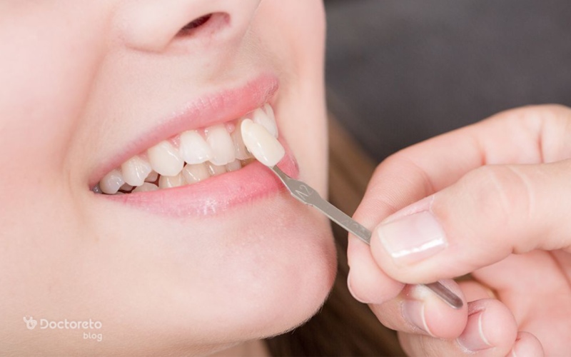 مزایای لمینت متحرک دندان چیست؟