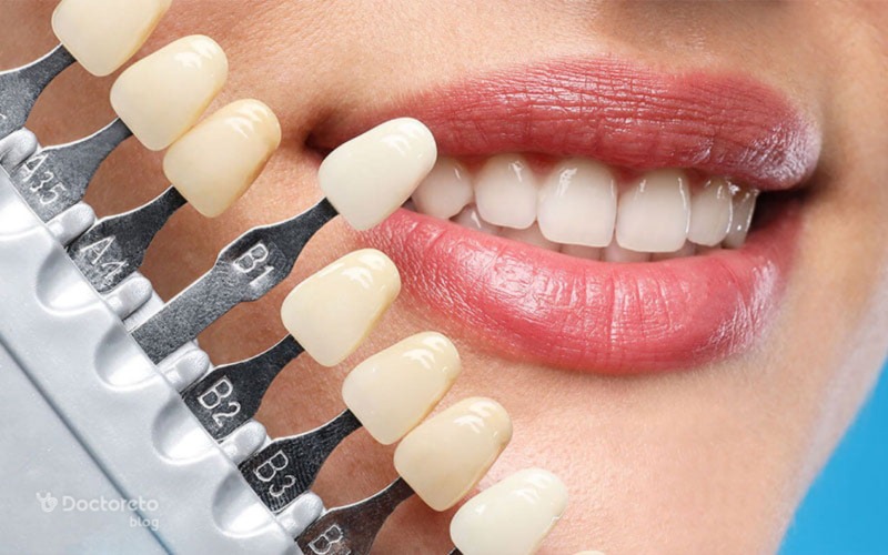 مهم ترین مزایای لمینت دندان چیست؟