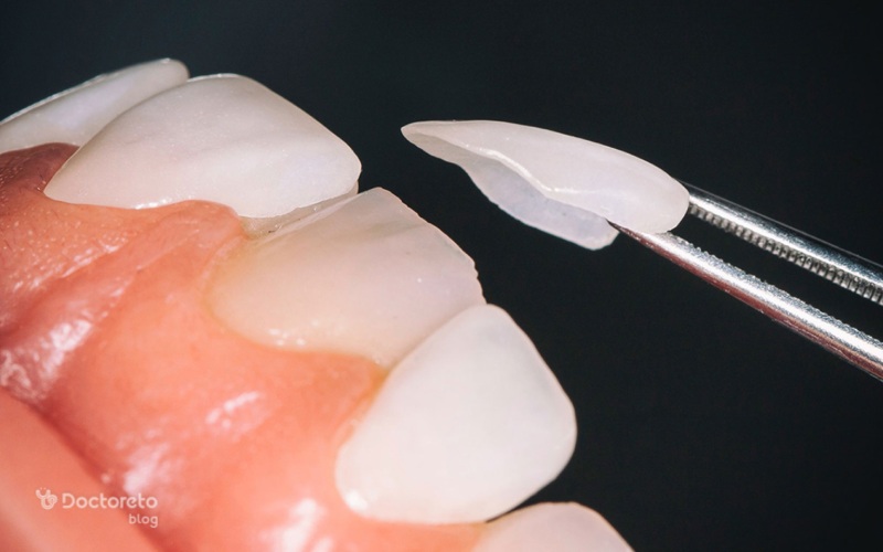 مهم ترین نکته مراقبت بعد از لمینت دندان چیست؟