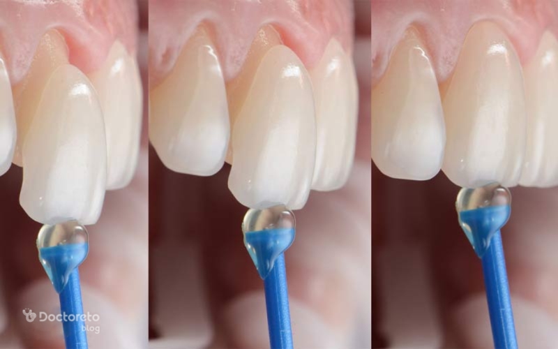 مراحل لمینت دندان با عکس چگونه است؟