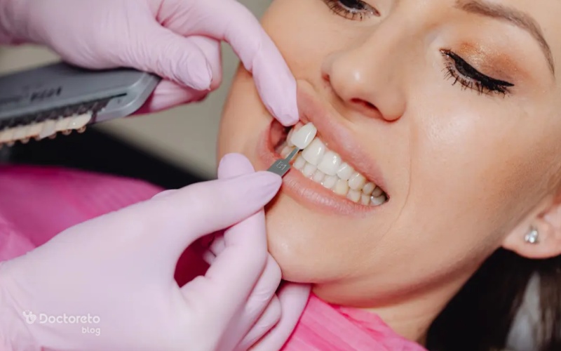 مراحل انجام و نصب لمینت دندان چگونه است؟