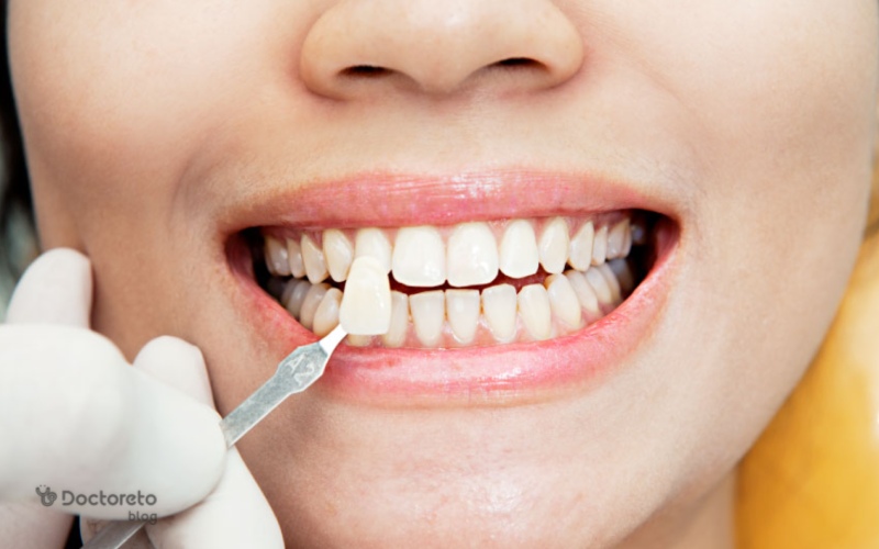 نحوه تعویض لمینت دندان چگونه است؟