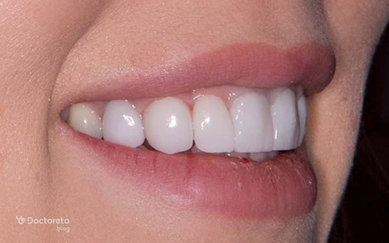 قیمت تعویض لمینت دندان در دکترِتو کلینیک چقدر است؟