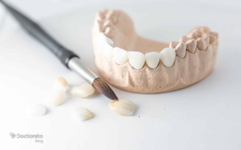 راه های پیشگیری از افتادن لمینت دندان کدامند؟