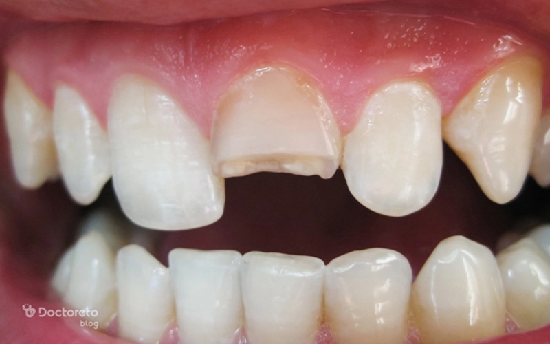 دلایل افتادن لمینت دندان چیست؟