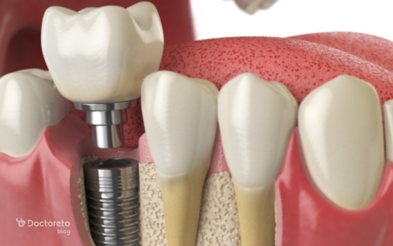 سخت ترین مرحله ایمپلنت دندان کدام است؟