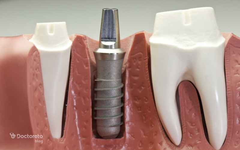 مراحل ایمپلنت فوری دندان چگونه است؟