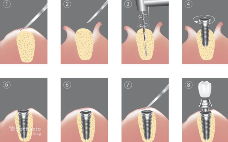 مراحل ایمپلنت دندان با عکس، ایمپلنت دندان چگونه انجام میشود؟