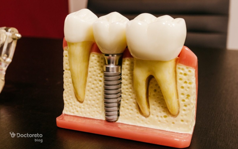 مشاوره اولین مرحله از مراحل ایمپلنت دندان است؟