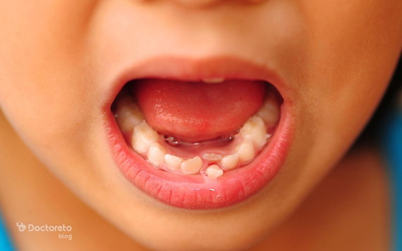 کاربردهای لمینت دندان برای کودکان چیست؟