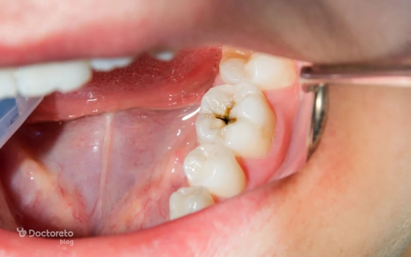 درمان نکردن دندان های پوسیده یا خراب قبل از نصب لمینت چه معایبی دارد؟