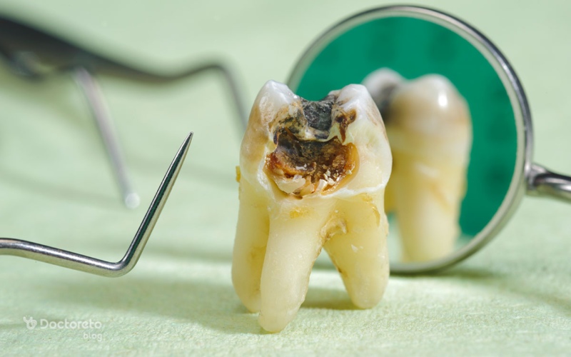 آیا روکش دندان ها را می توان بعد از پوسیدگی تعویض کرد؟