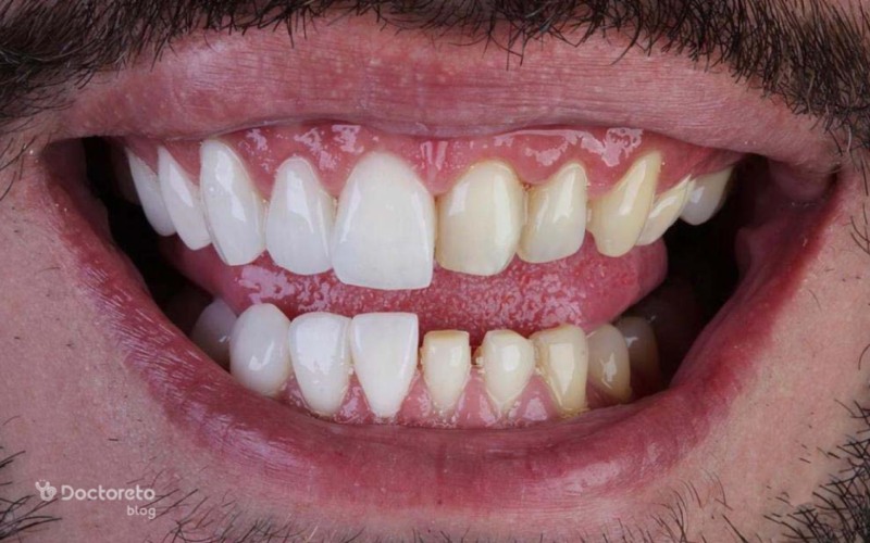 لمینت دندان بدون تراش بهتر است یا کامپوزیت دندان؟