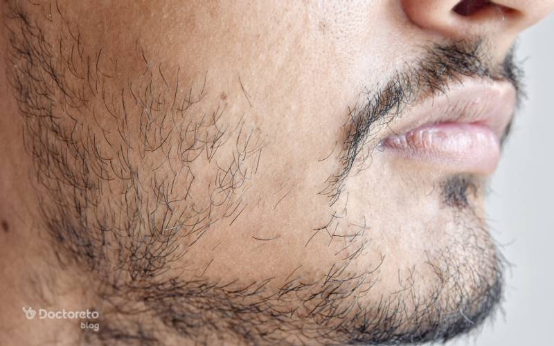 مزوتراپی ریش برای پرپشت شدن ریش استفاده می شود.