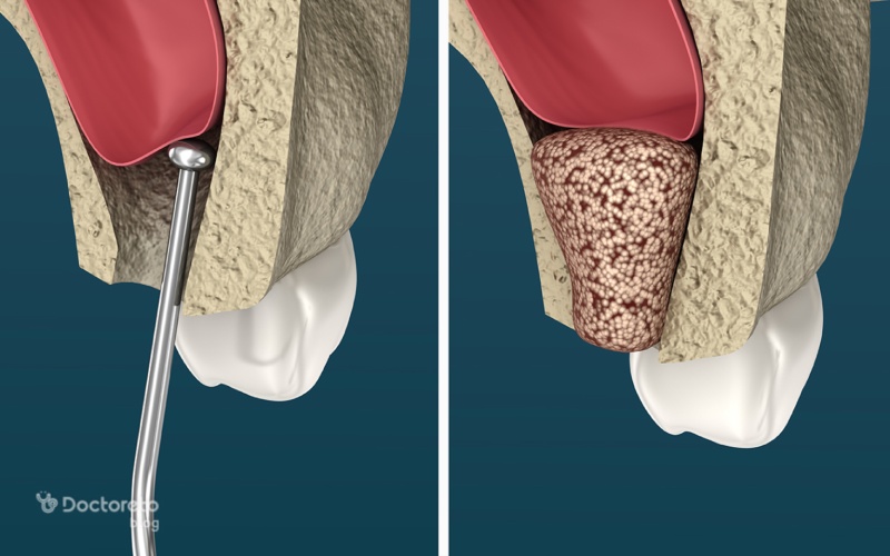 آیا می‌ توان عمل کاشت ایمپلنت دندان را همزمان با عمل لیفت سینوس انجام داد؟