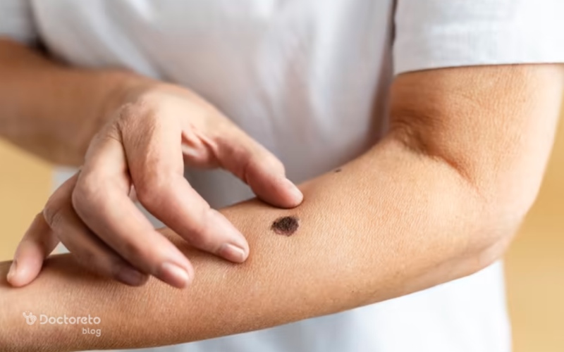 علایم سرطان پوست دست چیست؟